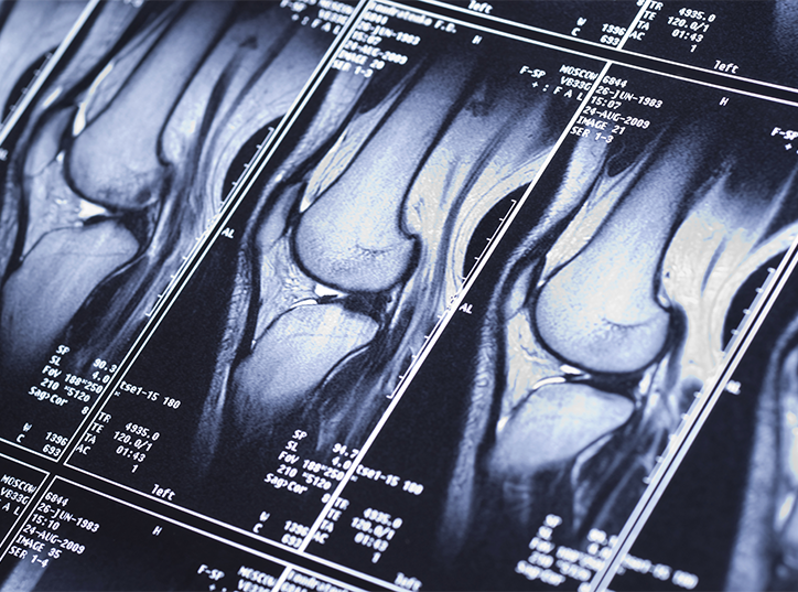 Knee MRI showing damage of cross-shaped ligaments